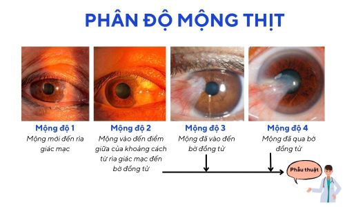 Hình ảnh phân độ mộng thịt.Nguồn: Bệnh viện Mắt Hoa Lư