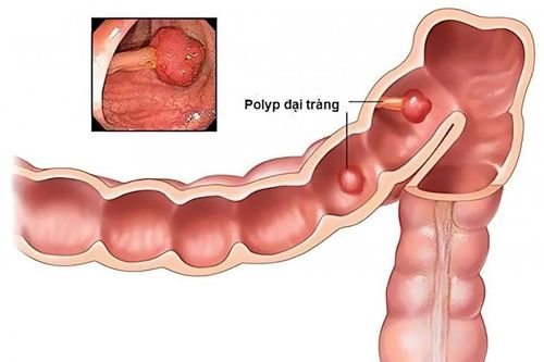 Phần lớn polyp lành tính, nhưng có khả năng tiến triển thành ung thư nếu không được phát hiện và xử trí phù hợp.