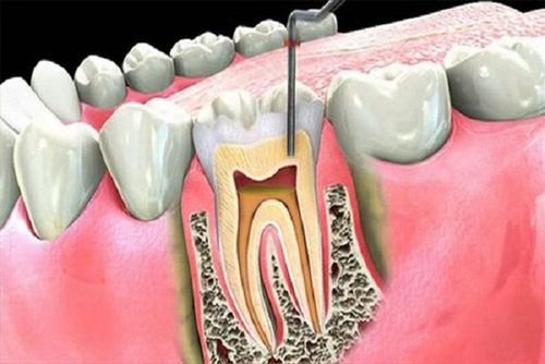 Nếu không được phát hiện, điều trị, bệnh có thể dẫn đến tiêu xương ổ răng, răng lung lay và cuối cùng là mất răng. Ảnh AI