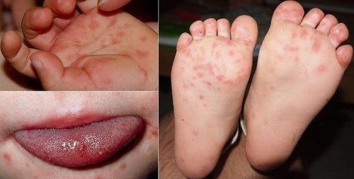 Tay chân miệng là bệnh truyền nhiễm quen thuộc ở trẻ nhỏ. Ảnh CDC Quảng Ninh