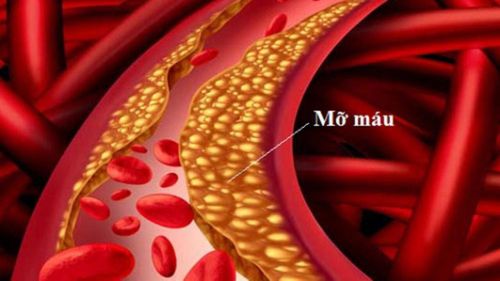 Mỡ máu cao thường không có triệu chứng nhưng có thể thúc đẩy xơ vữa động mạch. Ảnh AI.