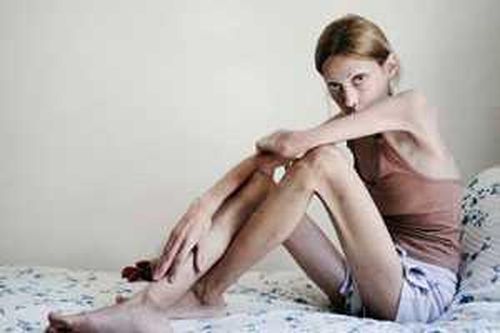 Người mẫu biếng ăn qua đời ở tuổi 28