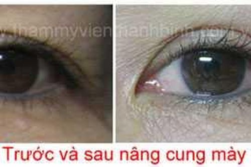 Tận mắt xem bác sĩ nâng cao cung mày