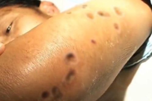 41 người chết, 1.500 người bị thương vì bị ong bắp cày đốt