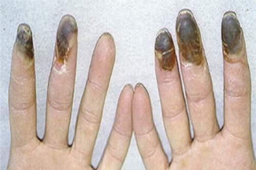 Hút nhiều thuốc lá có thể bị cụt chân tay
