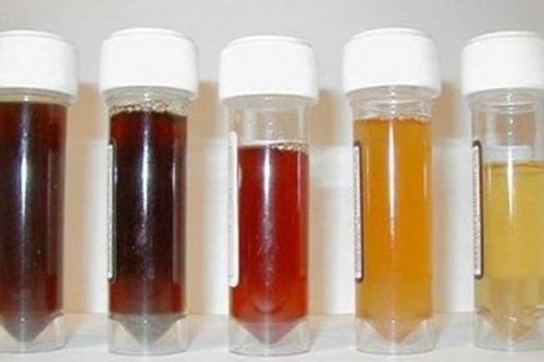Đoán bệnh thông qua màu sắc nước tiểu