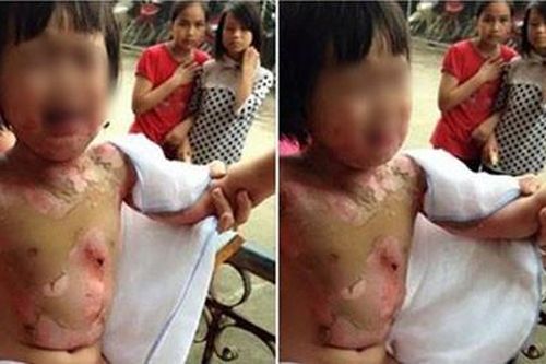 Đình chỉ 2 giáo viên vụ bé gái bị bỏng nửa người
