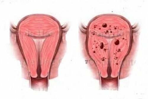 Phân biệt đau bụng kinh và lạc nội mạc tử cung