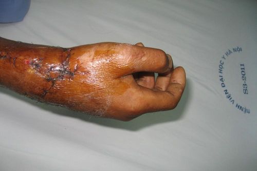 Bệnh viện ĐH Y Hà Nội ghép thành công bàn tay bị đứt rời