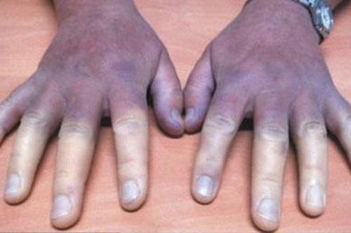 Sự thật bất ngờ vụ mổ sỏi thận bị cắt cụt tứ chi ở TP HCM
