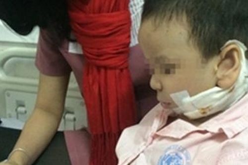 Thành công trong phẫu thuật kéo giãn xương hàm điều trị bệnh Pierre Robin cho trẻ
