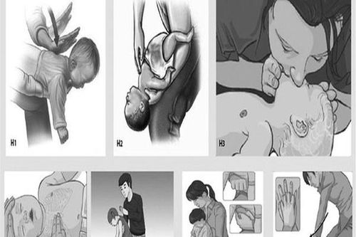 Sơ cứu hóc dị vật đường thở để tránh tử vong