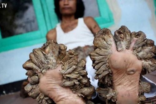 Căn bệnh đáng sợ có thật khủng khiếp hơn phim kinh dị