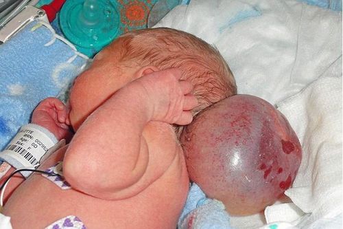 Em bé sinh ra với khối u bóng nước to bằng đầu
