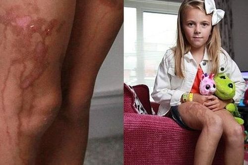 Sử dụng kem chống nắng, bé 9 tuổi bị cháy da nghiêm trọng