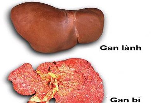 Giảm 1-2 kg/tháng, hãy nghĩ ngay đến ung thư gan