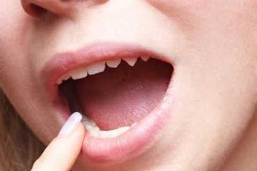 Dấu hiệu trong miệng cảnh báo bệnh nguy hiểm 'chết người'
