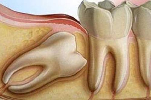 Không biết cách điều trị có thể mất mạng vì mọc răng khôn