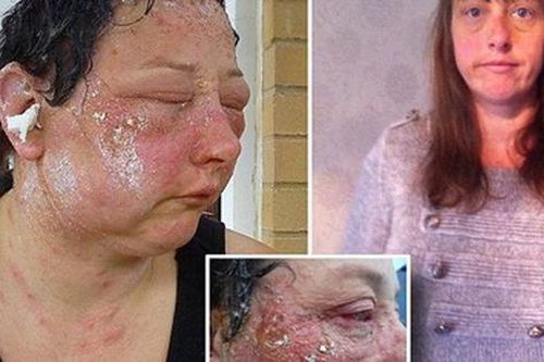 Kinh hãi những khuôn mặt phồng rộp, biến dạng vì thuốc nhuộm tóc
