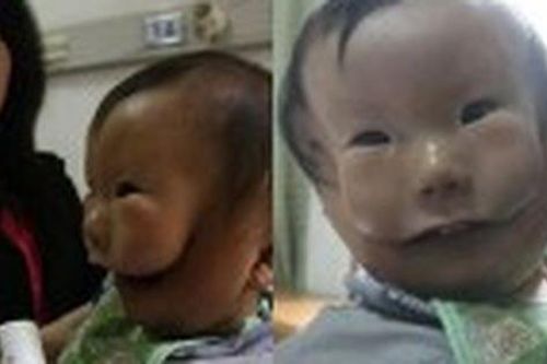 Siêu âm thai bình thường, mẹ chết lặng khi sinh con '2 mặt'