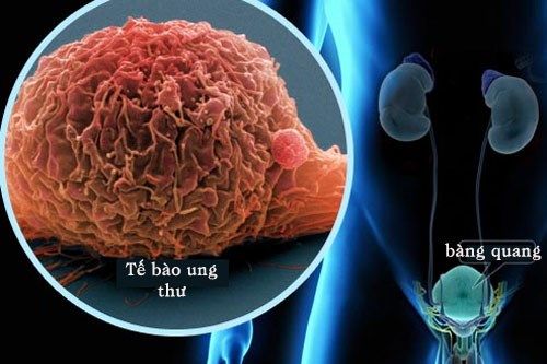 Phương pháp điều trị ung thư bàng quang hữu hiệu nhất