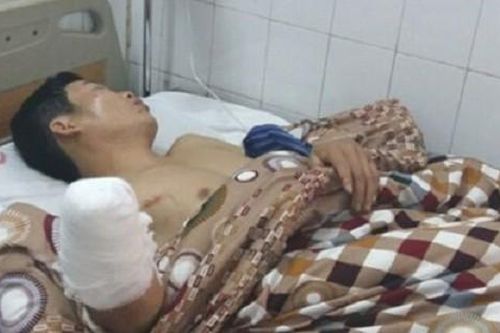 Tai nạn do đốt pháo đêm giao thừa, người mù mắt, kẻ cụt tay