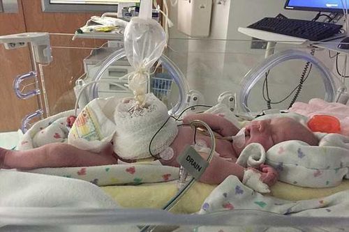 Em bé sinh ra với dạ dày, ruột, buồng trứng nằm ngoài bụng