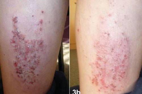 Điều trị viêm da cơ địa mạn tính bằng Dr Michaels Dermatinex thảo dược