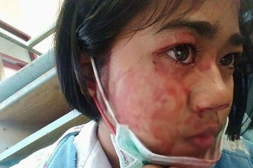 Mắc quái bệnh, bé gái cứ đau đầu căng thẳng là đổ mồ hôi máu