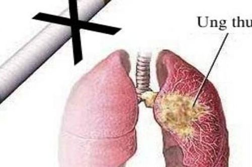 8 bệnh ung thư do hút thuốc lá