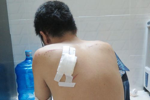 Nạn nhân kể lại giây phút bị chém, cướp xe máy ở Sài Gòn