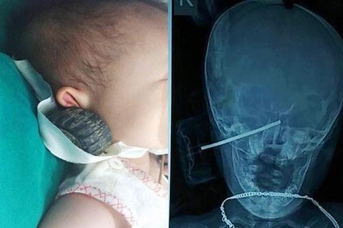Bé 11 tháng bị que thép xe đồ chơi xuyên vào đầu