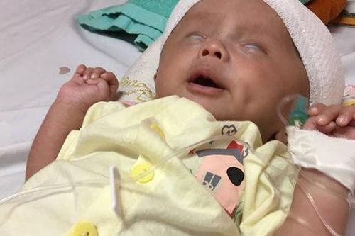 Xót xa bé trai mới 1 tháng tuổi đã 3 lần phẫu thuật vì não úng thủy