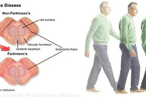 Dấu hiệu cho thấy bệnh Parkinson có thể chữa trị được