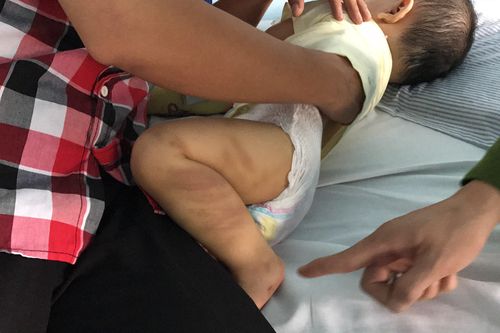 Bé trai 1 tuổi nghi bị bạo hành đã được ra viện