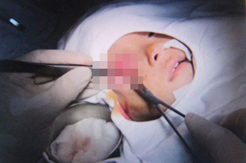 Viêm xoang gây biến chứng áp xe khổng lồ ở mắt bé trai 16 tháng