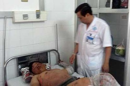 Bếp cồn cháy dữ dội, 11 người đang ăn tiệc cưới bị bỏng