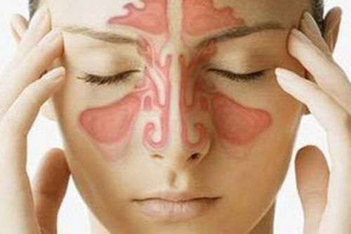 Kỳ diệu 3 bài thuốc chữa viêm xoang cực hiệu quả từ thảo dược
