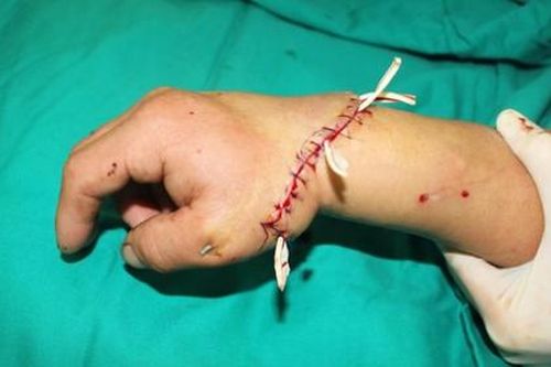 10 giờ nối thành công cánh tay bị máy chém đứt lìa