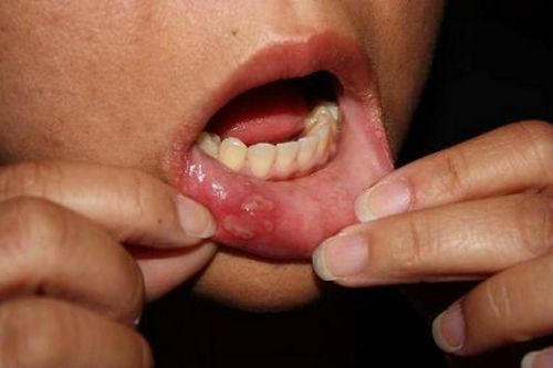 Cẩn trọng phân biệt nhiệt miệng và ung thư lưỡi