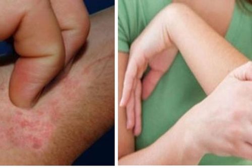 Điều cần biết khi bị ngứa mùa lạnh