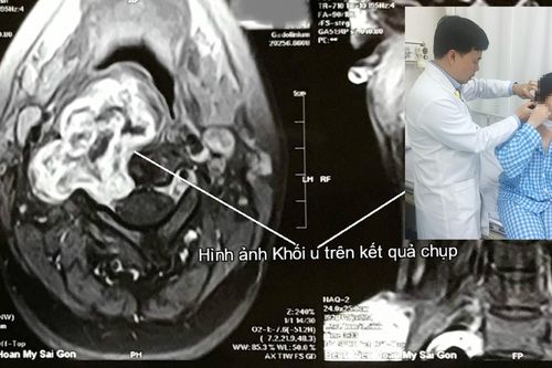 Giúp bệnh nhân bỏ u bao dây thần kinh cột sống cổ xâm lấn
