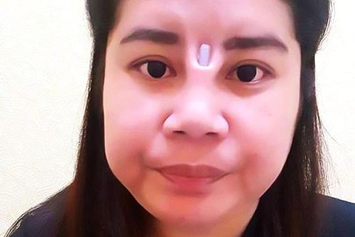 Sốc với khuôn mặt phẫu thuật thẩm mỹ hỏng