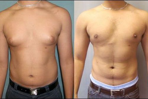Bị hội chứng vú to, người đàn ông phải đi phẫu thuật thẩm mỹ