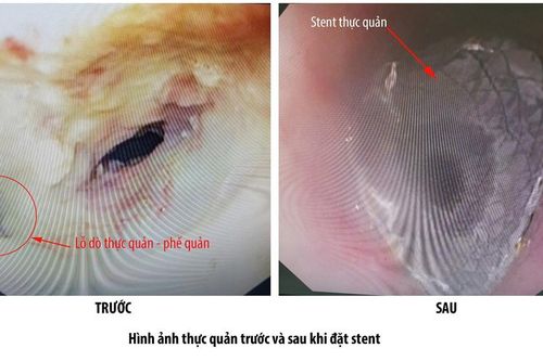 Cấp cứu thành công bệnh nhân bị căn bệnh hiếm gặp