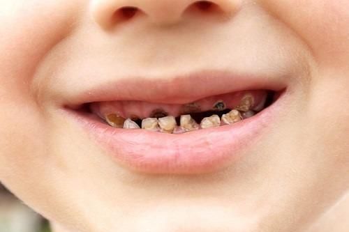 90% người Việt gặp vấn đề về răng miệng
