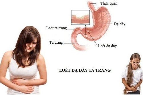 Nguyên nhân ngây ra bệnh loét dạ dày tá tràng ai cũng nên biết