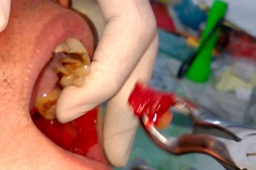 Răng số 8 là gì, răng số 8 mọc lệch có nên nhổ không?