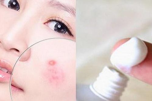 Bất ngờ trước cách trị mụn bọc chẳng tốn bao nhiêu tiền với kem đánh răng!