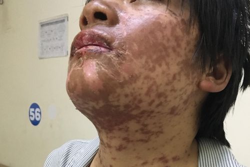 Cô gái bị biến dạng khuôn mặt vì tự ý dùng thuốc kháng sinh